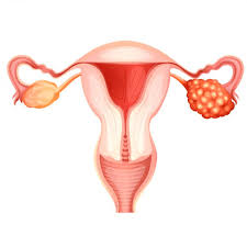 sintomas-comuns-da-sindrome-dos-ovarios-policisticos-o-que-voce-precisa-saber