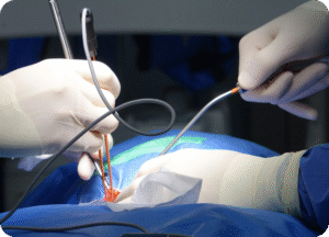 Vista detalhada das mãos de cirurgiões usando luvas brancas, realizando um procedimento de neurocirurgia com instrumental cirúrgico delicado. A área cirúrgica está coberta por tecidos azuis e sob forte iluminação.