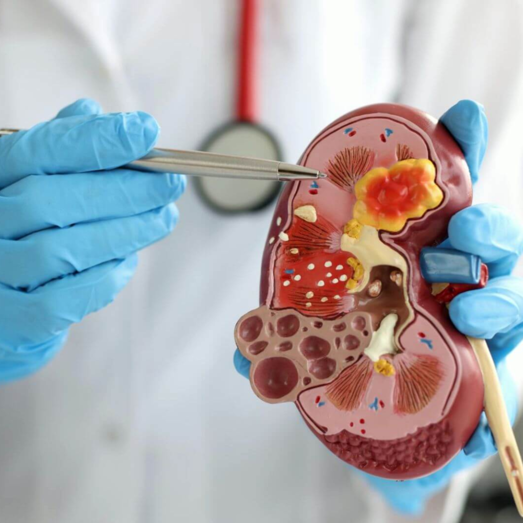 Exame de creatinina alto